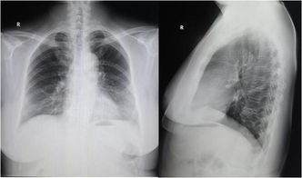 体检胸片没见异常,CT却看到了肺癌 怎么回事 