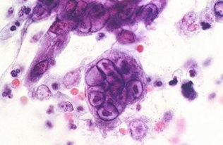 生殖器疱疹病毒感染途径