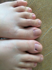 我脚趾甲上面长了黑点就是大拇指下方左右各长了一个 左边的那个还只是红 右边的的那个就很明显了 请问 