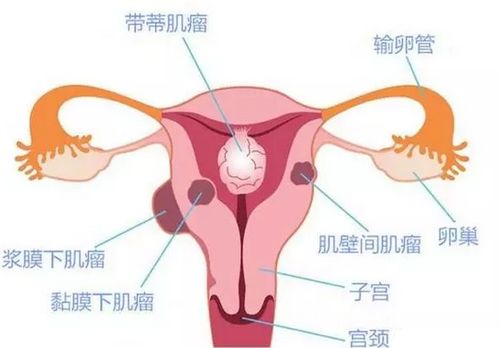 子宫肌瘤不可怕 定期妇科检查不能少 