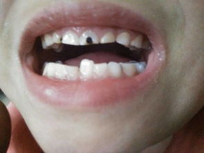 大家好,图片是我5岁的女儿牙齿,她从一出生就有个牙齿,掉了一次之后现在长成这样,有一个牙齿比旁边的 